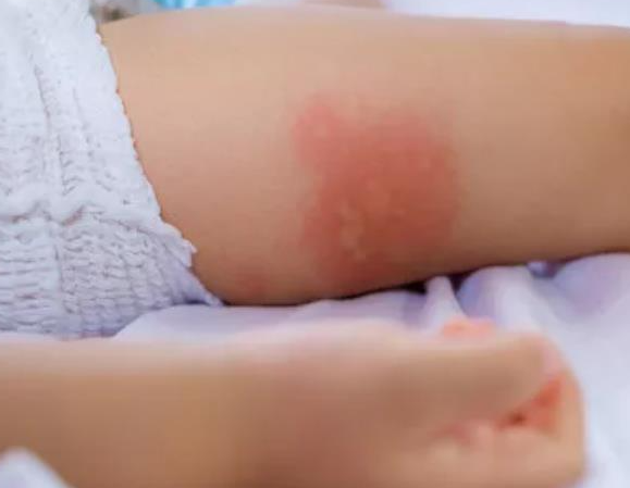 小孩得湿疹的初期症状是什么样子，有对照图片吗？
