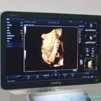 东京试管婴儿技术如何提高成功率？日本三代PGD/PGS检测如何降低出生缺陷风险？