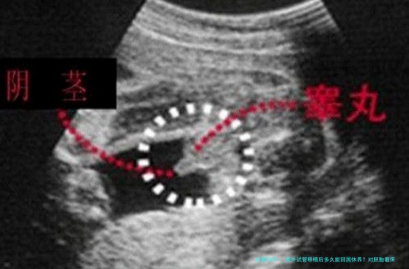国外试管移植后多久能回国休养？对胚胎着床有影响吗？