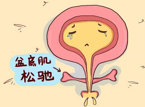 盆底肌松弛可能会导致漏尿的情况
