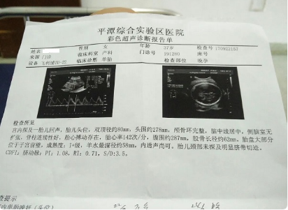 四维脐动脉看男女不准