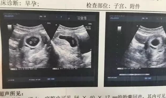 孕囊形状看男女是不准的