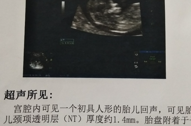 NT是排畸检查