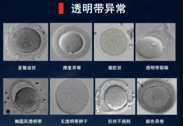 卵子没有透明带会导致不孕