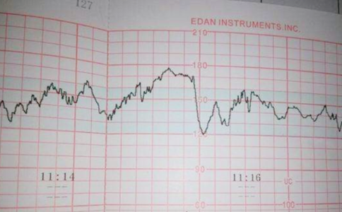 伴随胎动能看到胎心率上升