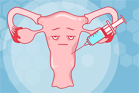 运动能改善子宫内膜状态