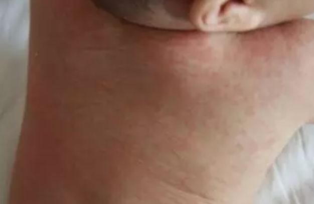 幼儿急疹症状之一是高热