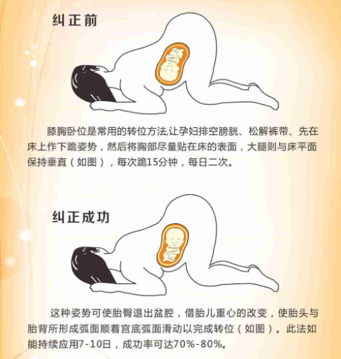 胸膝位能矫正胎位
