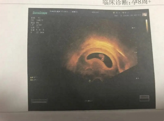 长条形孕囊可能生男宝宝