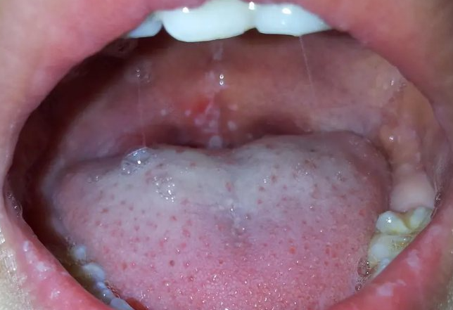 儿童患手足口病是什么样子，有具体的症状图片吗？