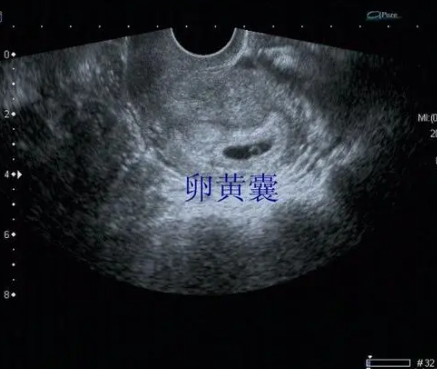 多大直径的孕囊没卵黄囊会建议放弃保胎？