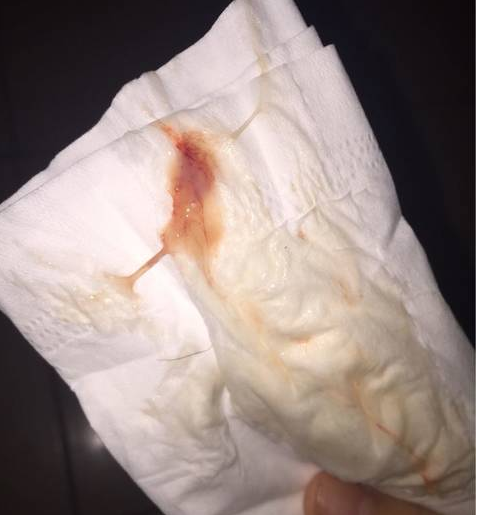 排卵期分泌物呈棕色