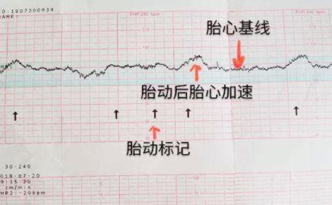 孕晚期要做胎心监护
