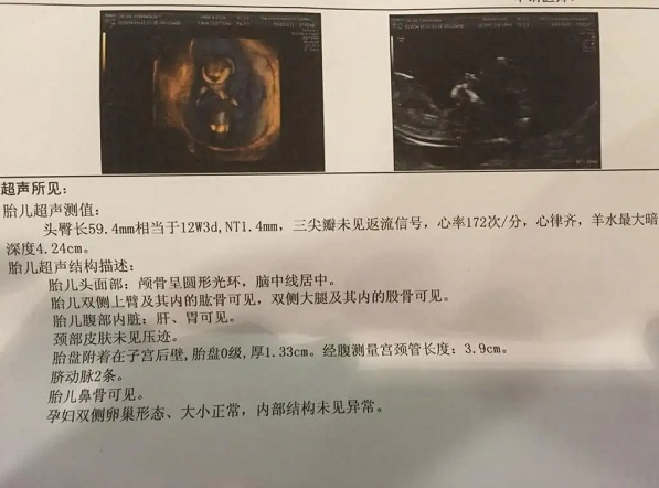 [已生男宝宝的nt单子，三个亮点暗示胎儿男女]