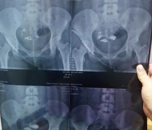 输卵管造影可能引起腹痛