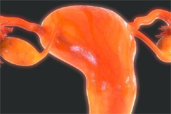 子宫内膜异位可分为4期