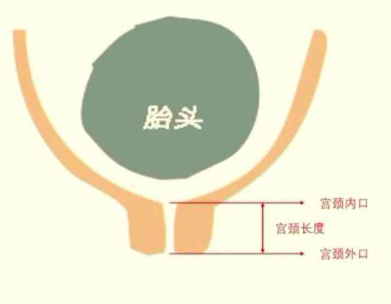 宫颈短容易早产