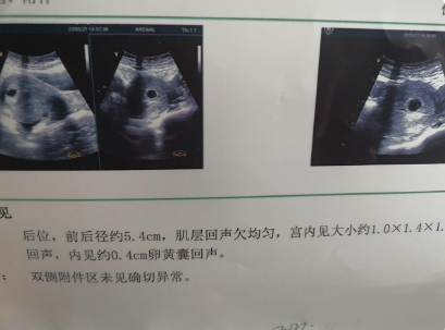 孕囊形状看男女不准