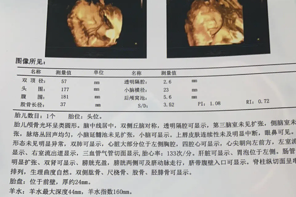 脐带绕颈一周彩超显示为V