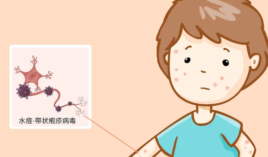 水痘是一种高度传染的疾病