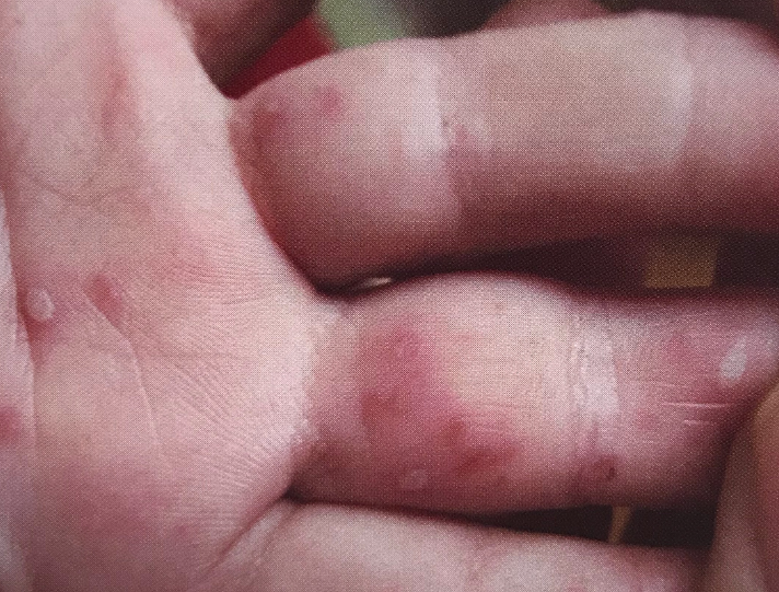 儿童患手足口病是什么样子，有具体的症状图片吗？