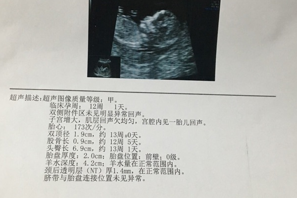 无创DNA检测比NT检查更准确