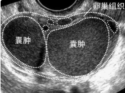 巧克力囊肿会影响生育