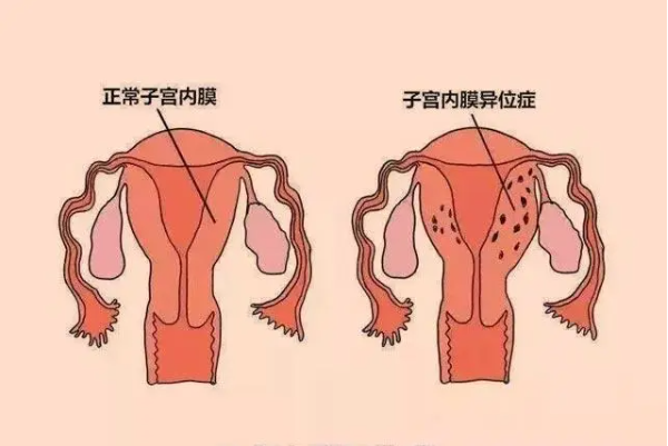 子宫内膜异位症的病因不明
