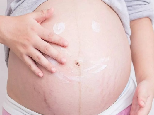 妊娠纹红色生女宝孩