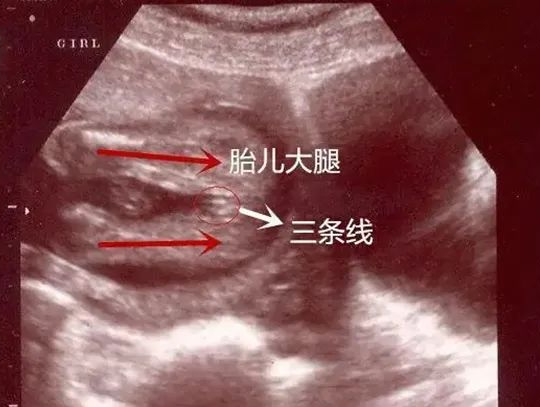 三条线是女宝说法不准